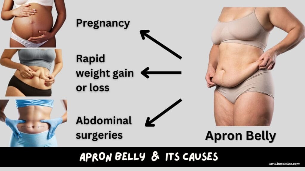 Apron-Belly-and-Its-Causes